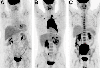 Imagen: Patrón de captación difuso de la médula ósea en 18F-FDG PET/CT. (A y B) Captación menor que (A) o similar a (B) que en el hígado fue considerada negativa para BMI. (C) Captación más alta que en el hígado fue asociada con anemia o procesos inflamatorios y también considerada negativa para BMI (Fotografía cortesía de la Sociedad de Medicina Nuclear e Imagenología Molecular).